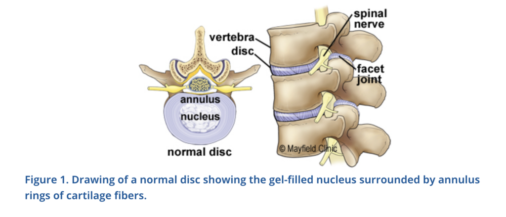 Diagram of an artificial cervical disc. Drawing of a normal disc showing the gel-filled nucleus surrounded by annulus rings of cartilage fibers.