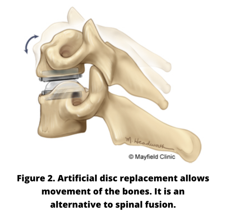 Artificial Cervical Disc Surgery - AANS