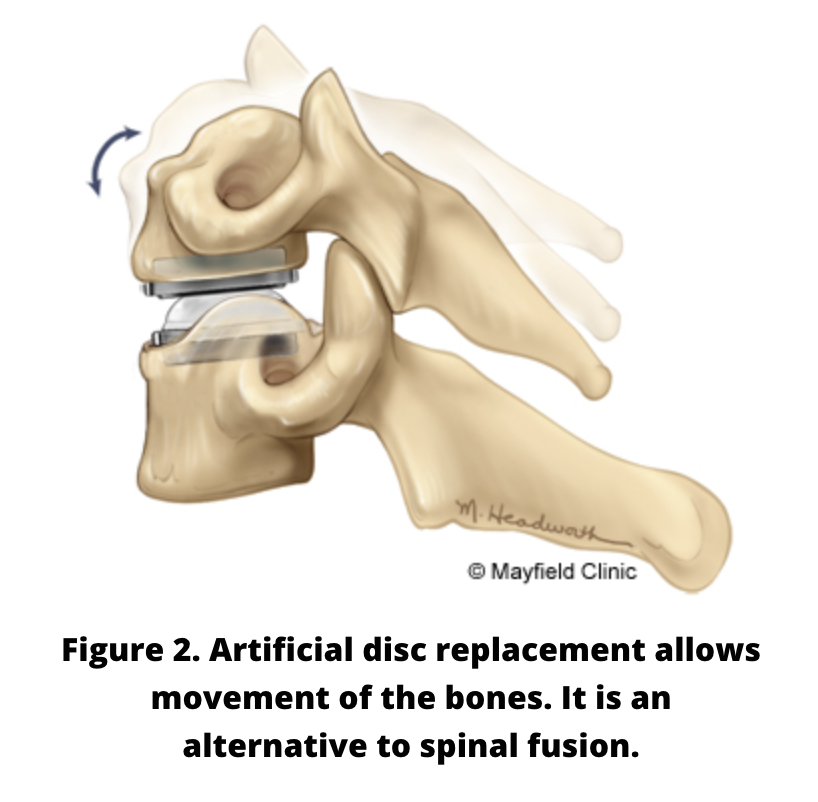 Graphic indicating spine joints with an artificial disc to replace the damaged disc.