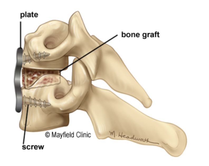 Graphic of a spinal fusion showing spinal bones with a plate attaching a bone graft.