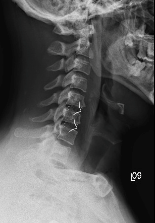 X Ray of Anterior Cervical