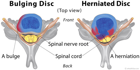 Bulging vs herniated disc