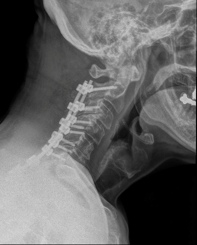 x ray of a posterior cervical Laminectomy and Fusion