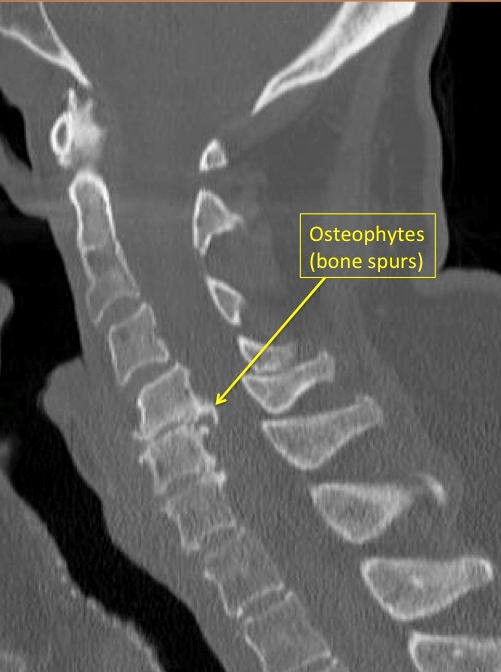 Osteophytes bone spurs