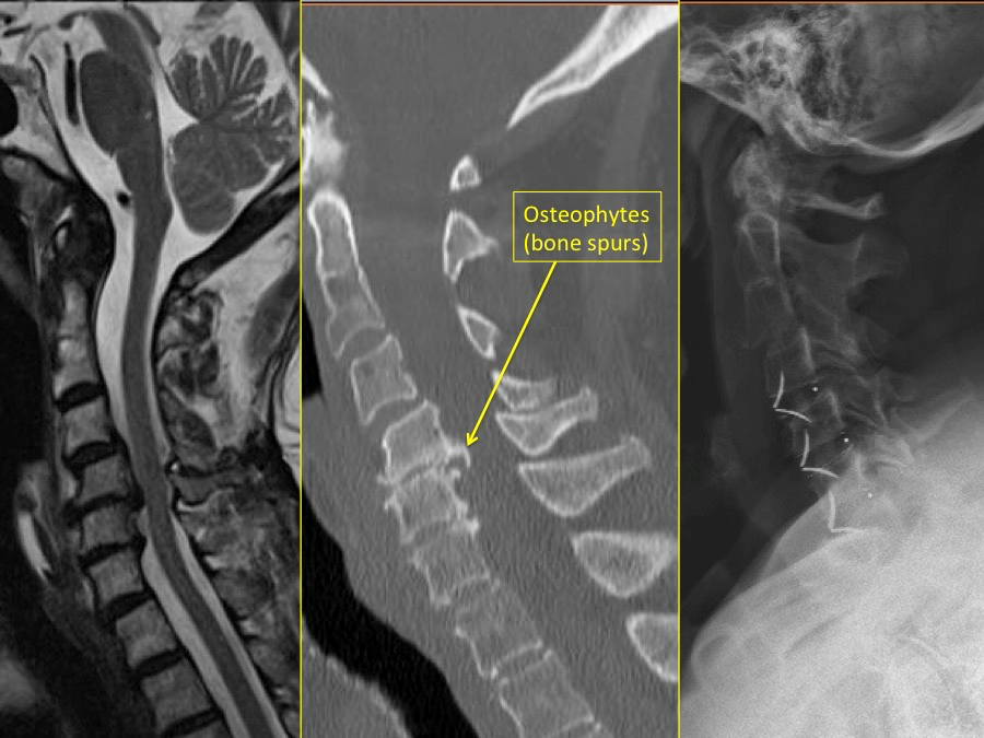 cervical stenosis X-ray