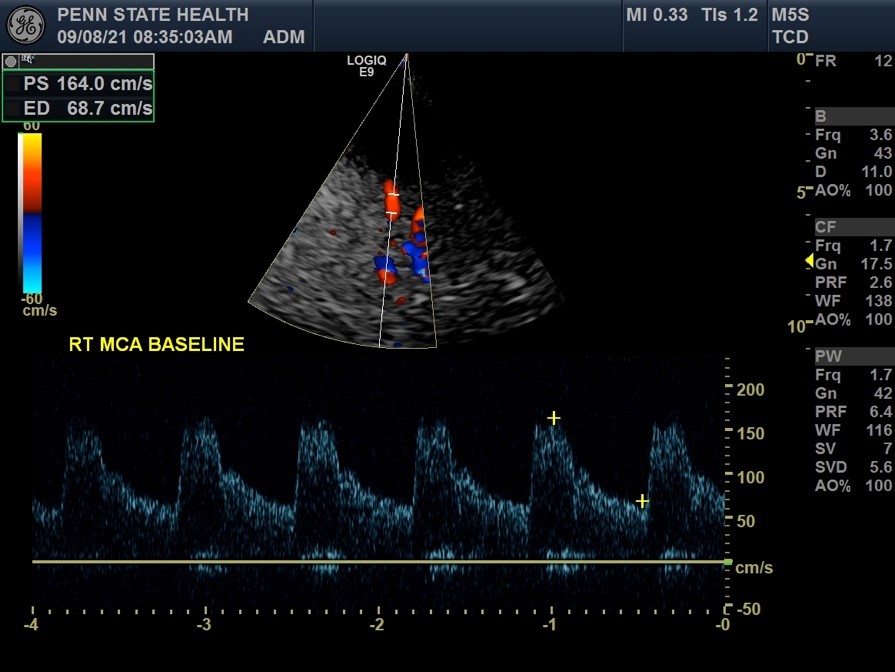Transcranial doppler ultrasound (TCD)