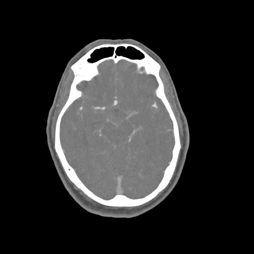 Computed tomography angiography, arteriovenous malformation with corresponding IPH in left temporal lobe
