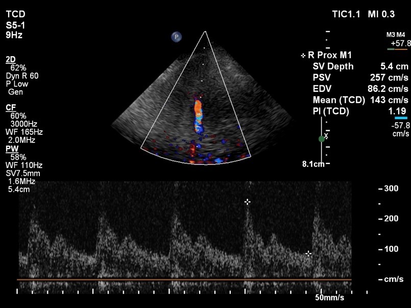 Transcranial doppler ultrasound (TCD)